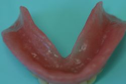 新義歯内面（下顎）