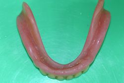 旧義歯　（下顎　内側）