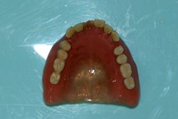 旧義歯（上顎外側）