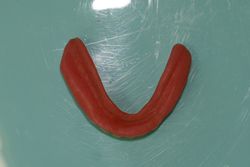 旧義歯（下顎内側）