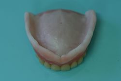 新義歯（上顎ティシュコンディショナー）