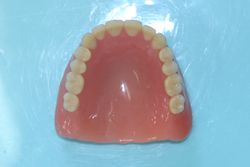 新義歯（上顎外側）
