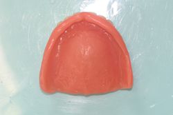 新義歯（上顎内側）