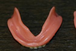 新義歯(下顎内側)