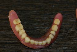 旧義歯（下顎外側）