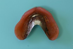 旧義歯（上顎内側）