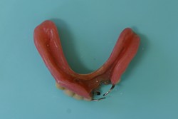 旧義歯（下顎内側）