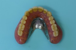 旧義歯（上顎外側）