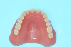 新義歯（上顎外側）