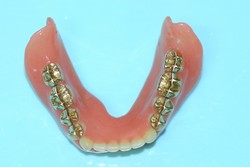 新義歯（下顎外側）