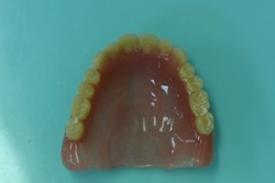 旧義歯（上顎　外側）